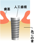 インプラント挿入イメージ