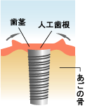 インプラントと骨が接合した状態