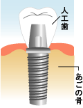 インプラントへ土台を取り付けます