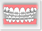 セラミック矯正の装置