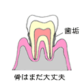 歯肉炎