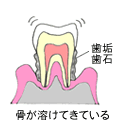 歯周病中程度（歯周病）